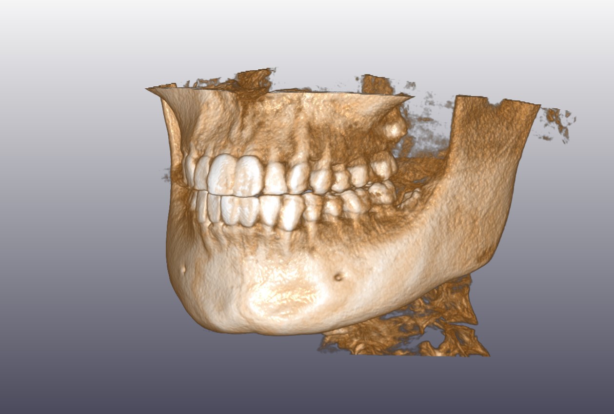顎骨CT